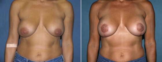 dr-grzeskiewicz-breast-lift-01a