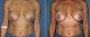 Dr. Grzeskiewicz Breast Lift Patient 1