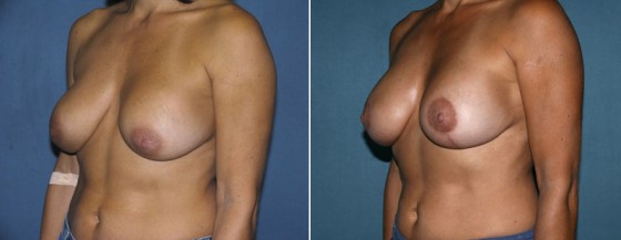 dr-grzeskiewicz-breast-lift-01b