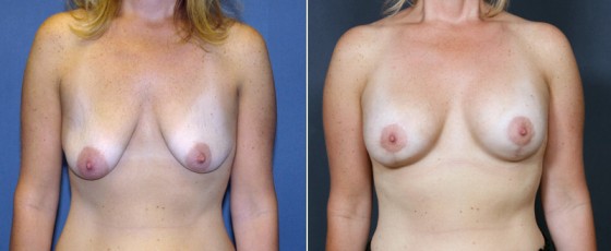 dr-grzeskiewicz-breast-lift-02a