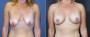 Dr. Grzeskiewicz Breast Lift Patient 2