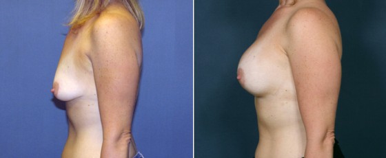 dr-grzeskiewicz-breast-lift-02b
