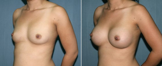 dr-grzweski-breast-augmentation-03b
