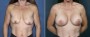 Dr. Grzeskiewicz Breast Augmentation Patient 24