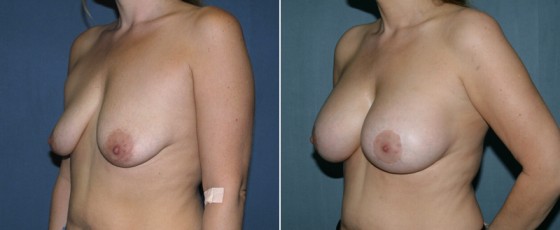 dr-grzweski-breast-augmentation-05b