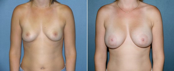 dr-grzweski-breast-augmentation-11a