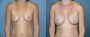 Dr. Grzeskiewicz Breast Augmentation Patient 23