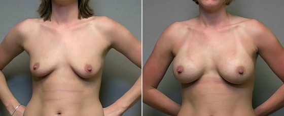 dr-salt-breast-augmentation-56a