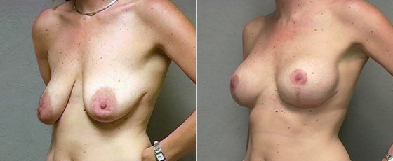 dr-saltz-breast-aug-lift-03b