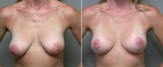 dr-saltz-breast-aug-lift-05a