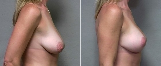 dr-saltz-breast-aug-lift-05c