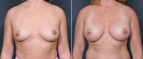 dr-saltz-breast-augmentation-15a
