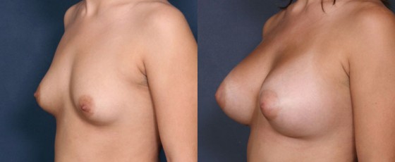 dr-saltz-breast-augmentation-17b