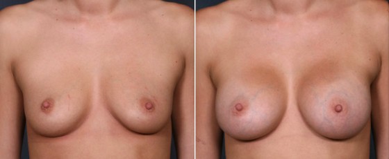 dr-saltz-breast-augmentation-20a