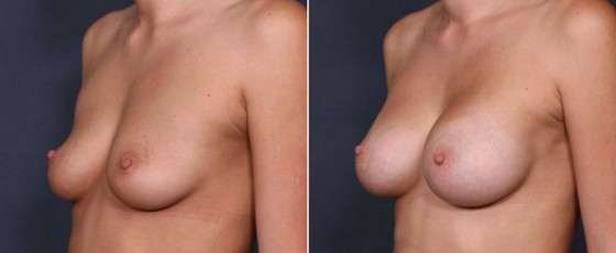 dr-saltz-breast-augmentation-20b