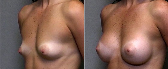 dr-saltz-breast-augmentation-21b
