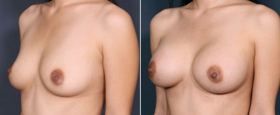 dr-saltz-breast-augmentation-22b