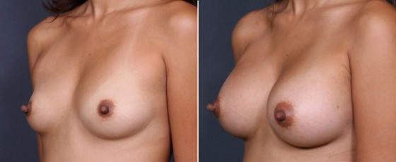 dr-saltz-breast-augmentation-24b