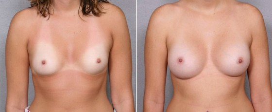 dr-saltz-breast-augmentation-25a