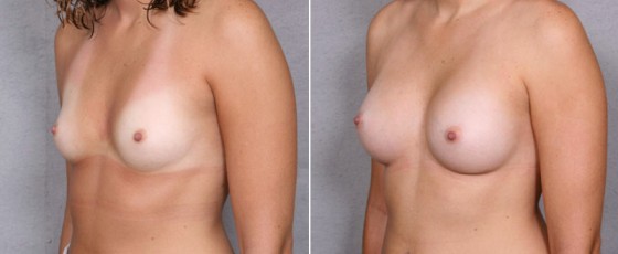 dr-saltz-breast-augmentation-25b