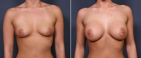 dr-saltz-breast-augmentation-26a