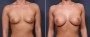 Dr. Saltz Breast Augmentation Patient 1