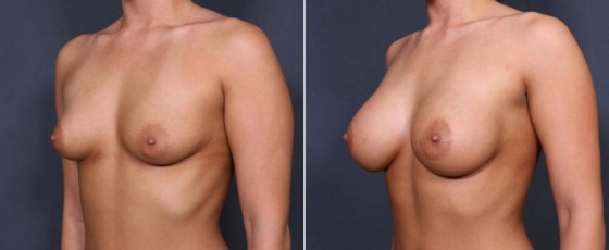 dr-saltz-breast-augmentation-26b