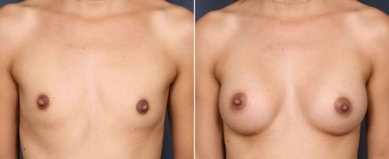 dr-saltz-breast-augmentation-27a