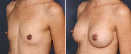 dr-saltz-breast-augmentation-27b