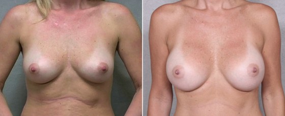 dr-saltz-breast-augmentation-28a