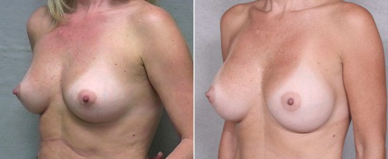 dr-saltz-breast-augmentation-28b