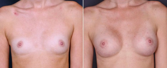 dr-saltz-breast-augmentation-31a