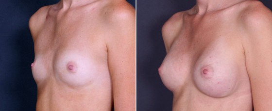 dr-saltz-breast-augmentation-31b