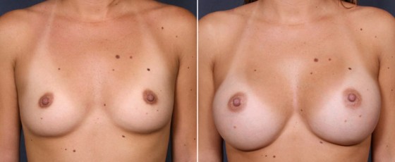 dr-saltz-breast-augmentation-32a