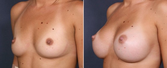 dr-saltz-breast-augmentation-32b
