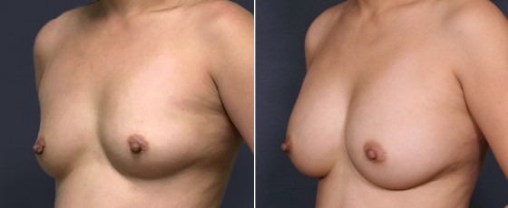 dr-saltz-breast-augmentation-34b