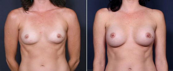 dr-saltz-breast-augmentation-36a