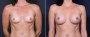 Dr. Saltz Breast Augmentation Patient 16