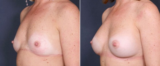 dr-saltz-breast-augmentation-38b