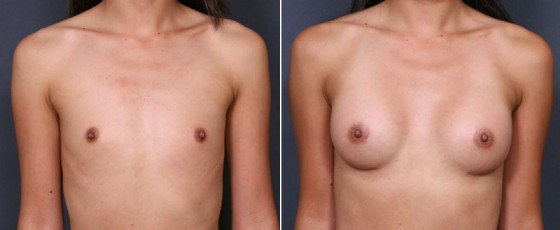dr-saltz-breast-augmentation-39a