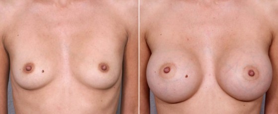 dr-saltz-breast-augmentation-40a