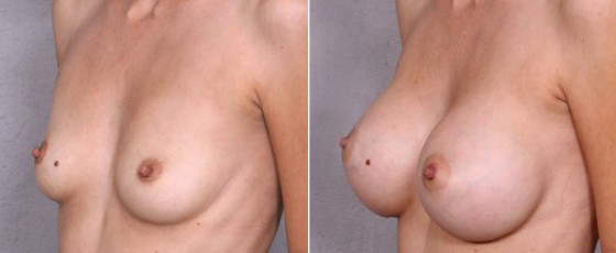 dr-saltz-breast-augmentation-40b