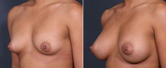 dr-saltz-breast-augmentation-42b
