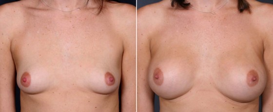 dr-saltz-breast-augmentation-45a