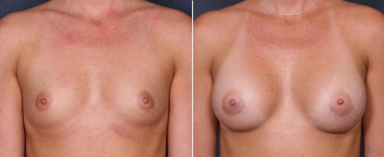 dr-saltz-breast-augmentation-46a