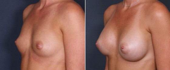dr-saltz-breast-augmentation-46b
