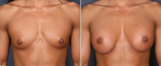 dr-saltz-breast-augmentation-49a