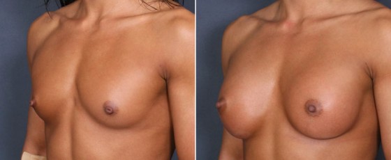 dr-saltz-breast-augmentation-49b