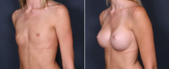 dr-saltz-breast-augmentation-52b