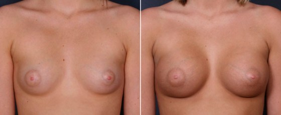 dr-saltz-breast-augmentation-54a